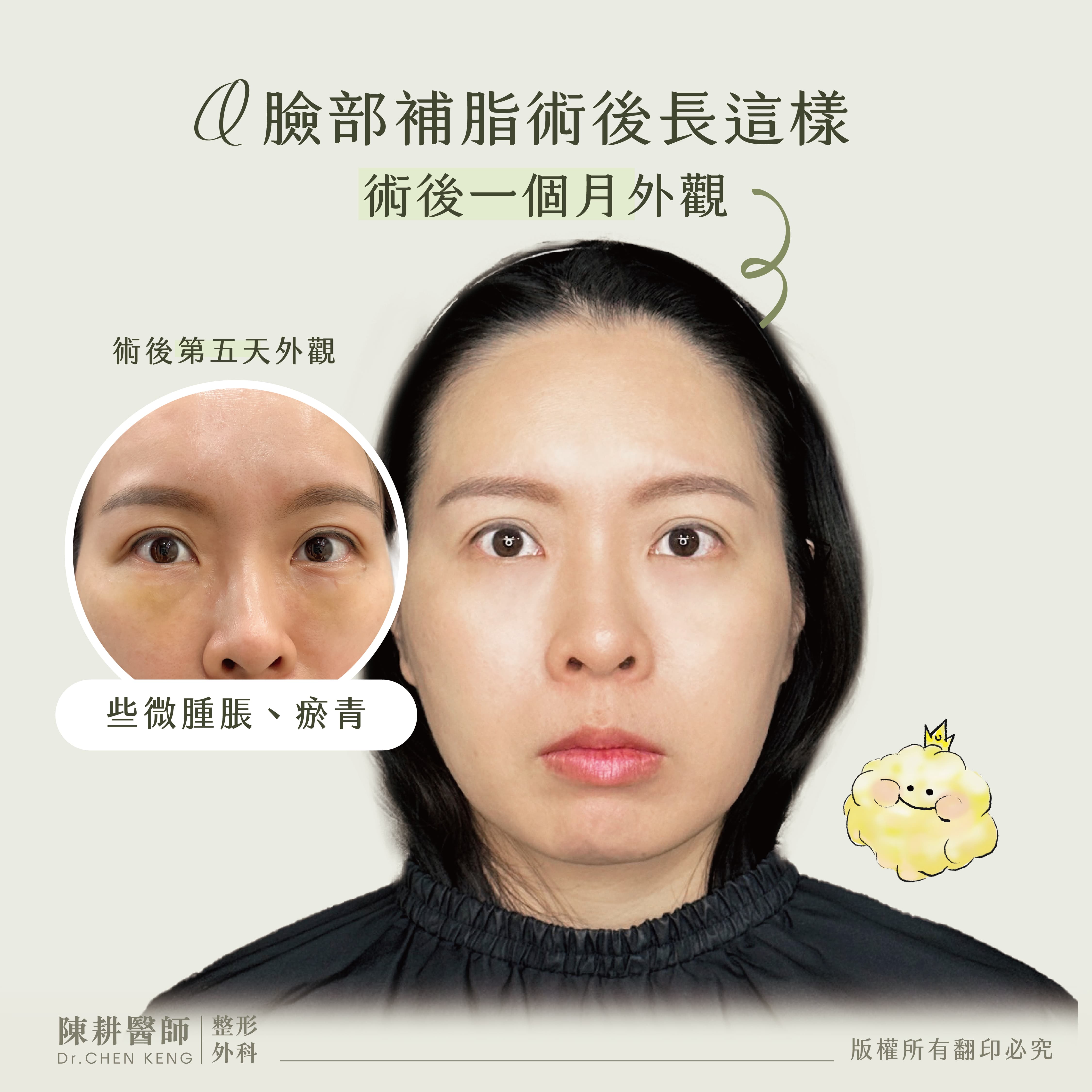 脂肪補臉術後恢復期